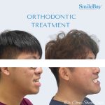 Side profile before and after orthodontic treatment showing correction of Class III malocclusion and open bite by Dr. Chew at SmileBay Dental.