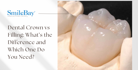 Close-up of a natural-looking dental crown on a tooth model at SmileBay Dental