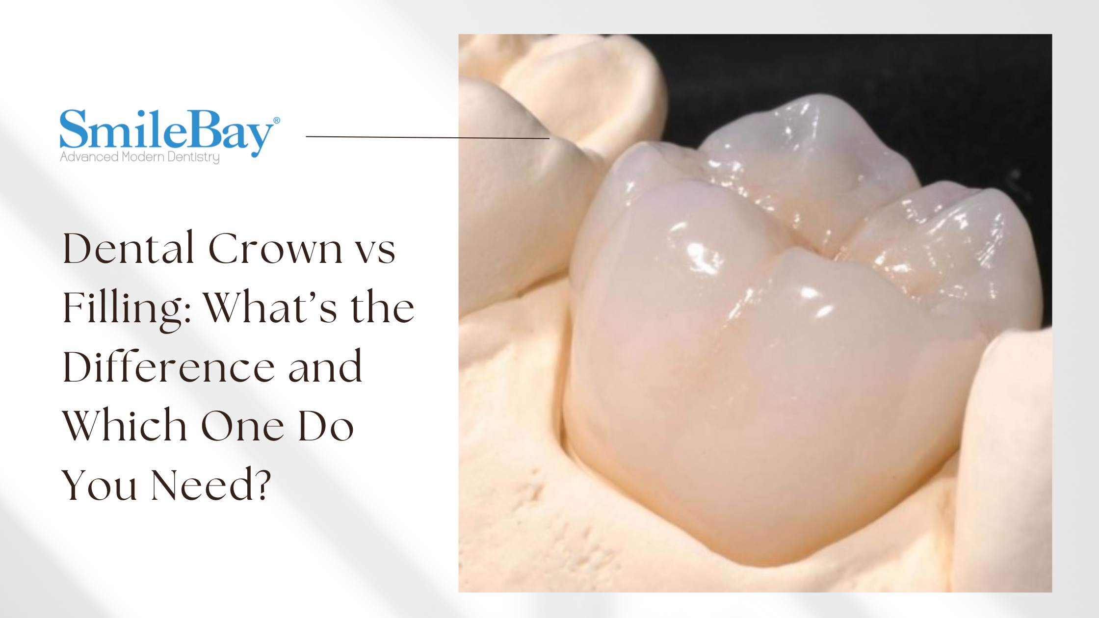 Close-up of a natural-looking dental crown on a tooth model at SmileBay Dental