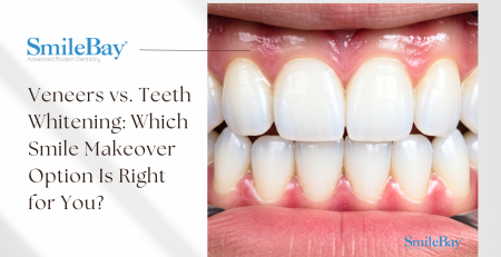 Close-up of natural-looking dental veneers on upper and lower teeth