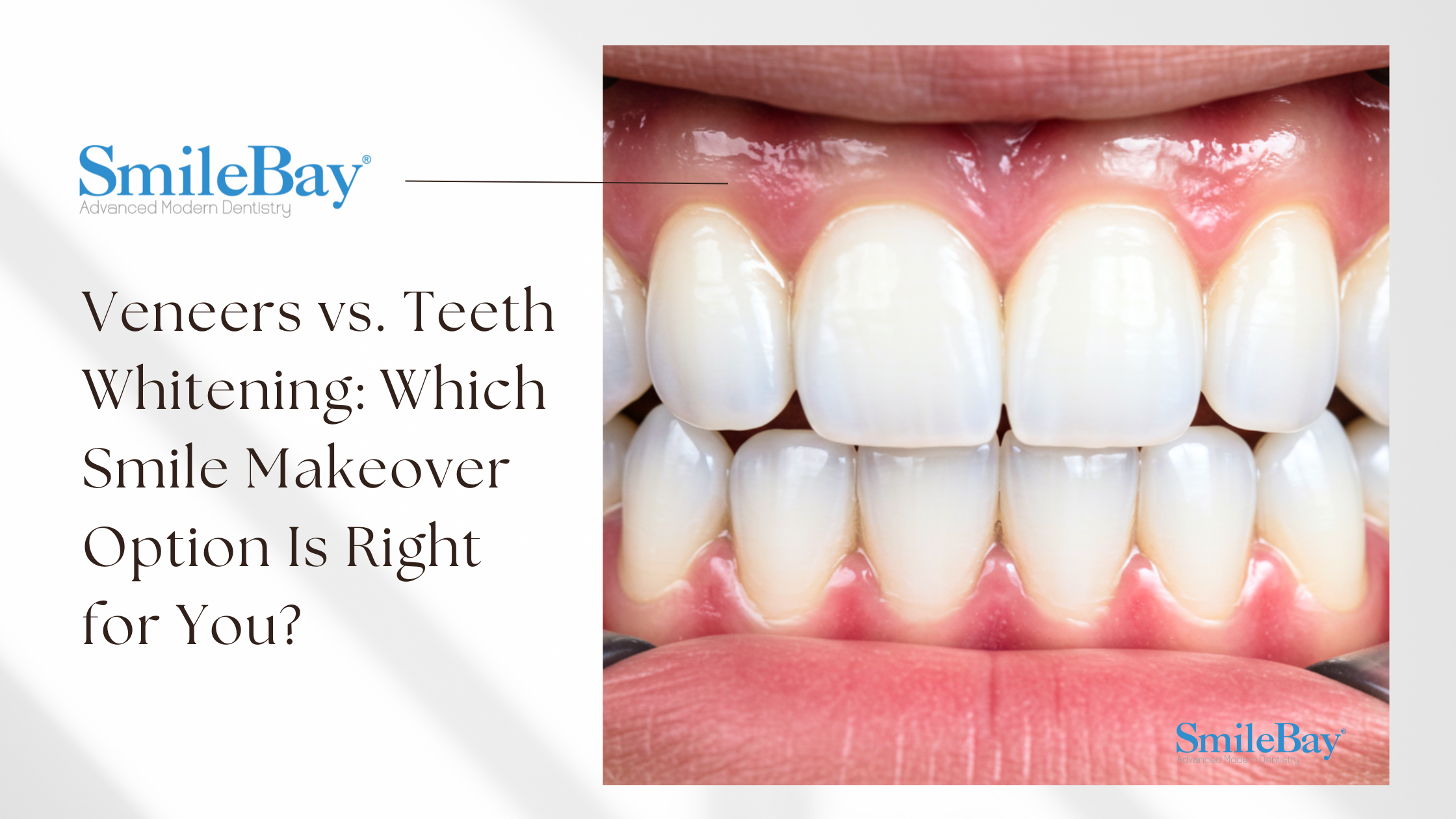 Close-up of natural-looking dental veneers on upper and lower teeth