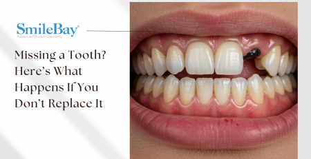 Close-up of a person’s smile showing a missing upper tooth with surrounding teeth shifting, used to illustrate the consequences of not replacing a lost tooth – SmileBay Dental