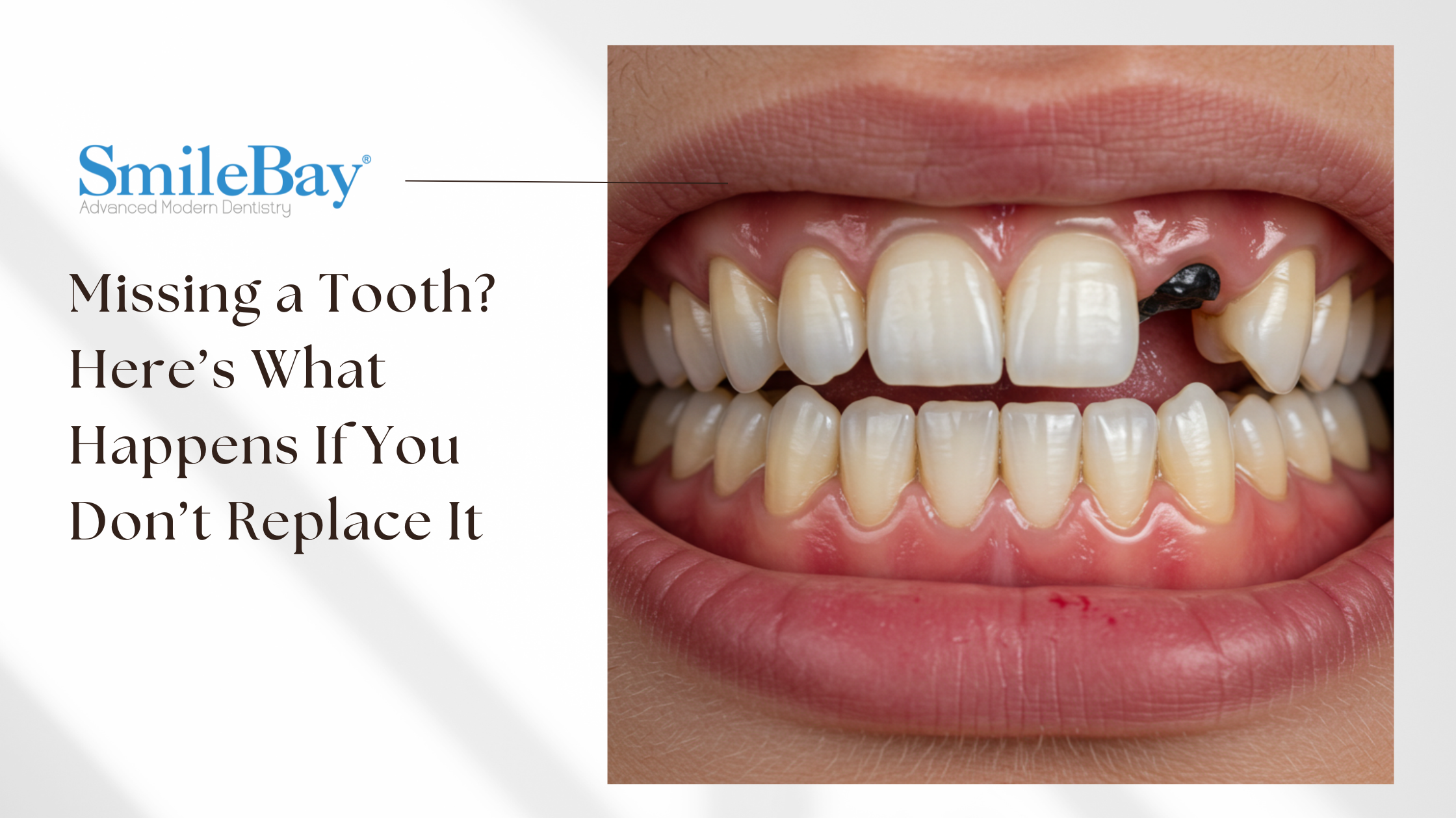 Close-up of a person’s smile showing a missing upper tooth with surrounding teeth shifting, used to illustrate the consequences of not replacing a lost tooth – SmileBay Dental
