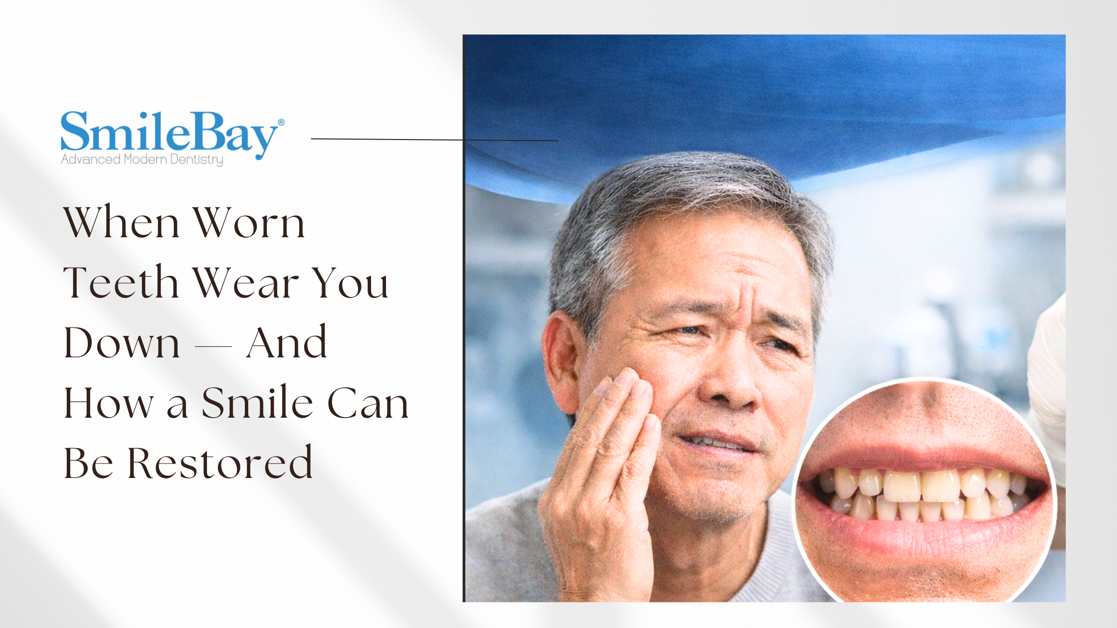 Worn teeth treatment in Penang at SmileBay Dental Island 88 with crowns and night guard