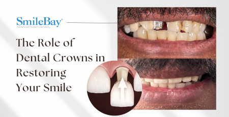 Before and after dental crowns treatment at SmileBay Dental Penang