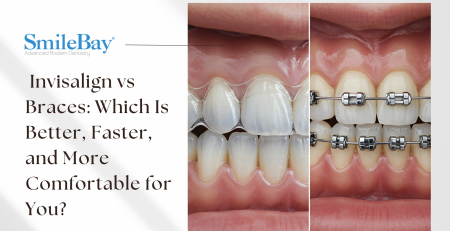 Comparison Invisalign vs braces