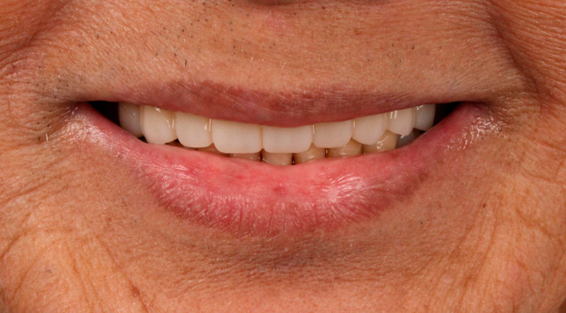 Close-up of an older adult smiling after receiving dental treatment showing clean, aligned, and natural-looking teeth