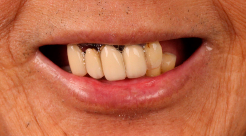 Close-up of a patient’s smile before dental treatment showing discolored, worn, and misaligned teeth